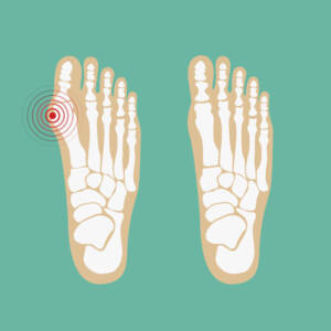 bump on my foot bunion
