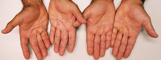 Dupuytren's Disease Dupuytren's Disease