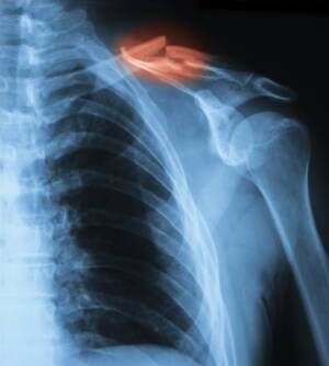 Fractured clavicle from hockey injury