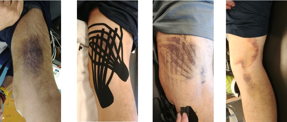 does kinesio tape work after surgery